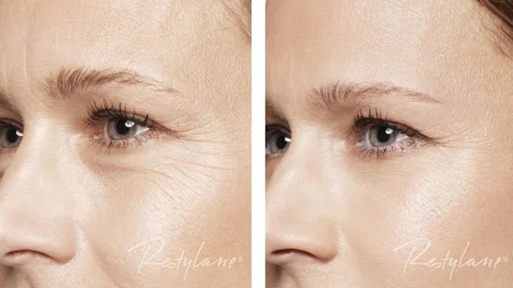 restylane-skin-booster Pmlajevanje kože s hialuronsko kislino Maribor