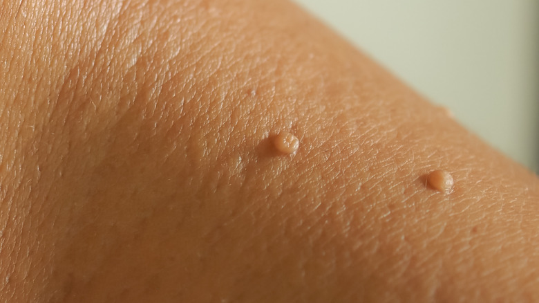Mehki fibromi – odstranjevanje fibromov | Vitalmed Maribor
