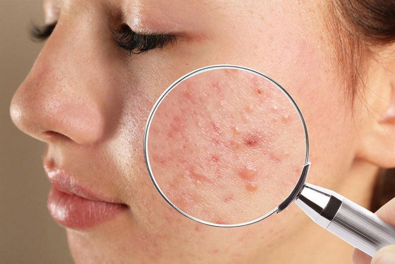 Akne: vzroki, vrste in zdravljenje – kdaj k dermatologu?