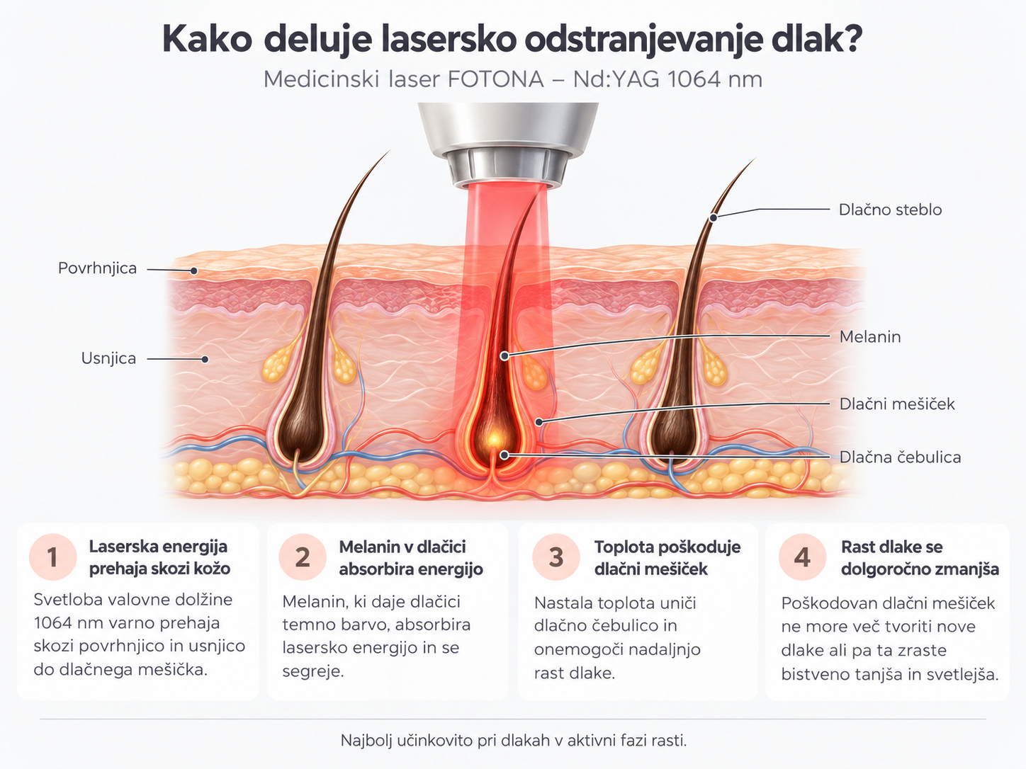Kako poteka lasersko odstranjevanje dlak?