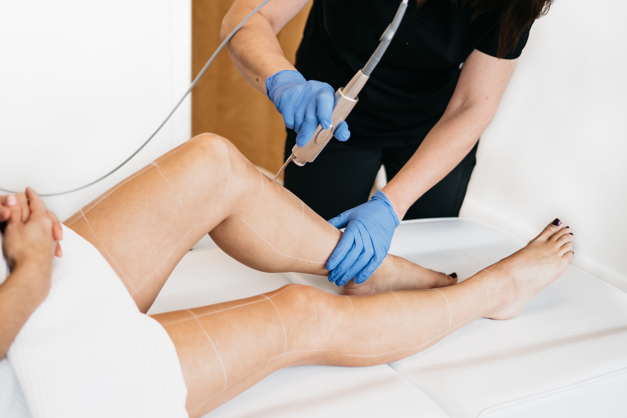 Lasersko odstranjevanje dlak z medicinskim laserjem FOTONA. Vitalmed Maribor