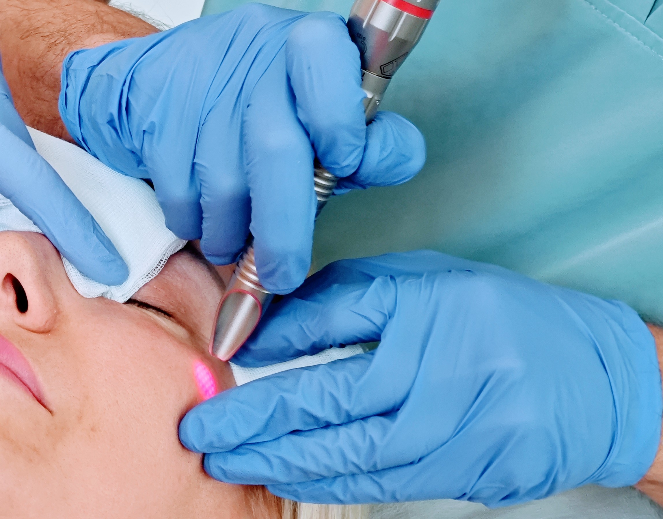 Vodič za pomlajevanje obraza – FOTONA laser 4D, SmoothEye, VectorLift, gubice in žilice